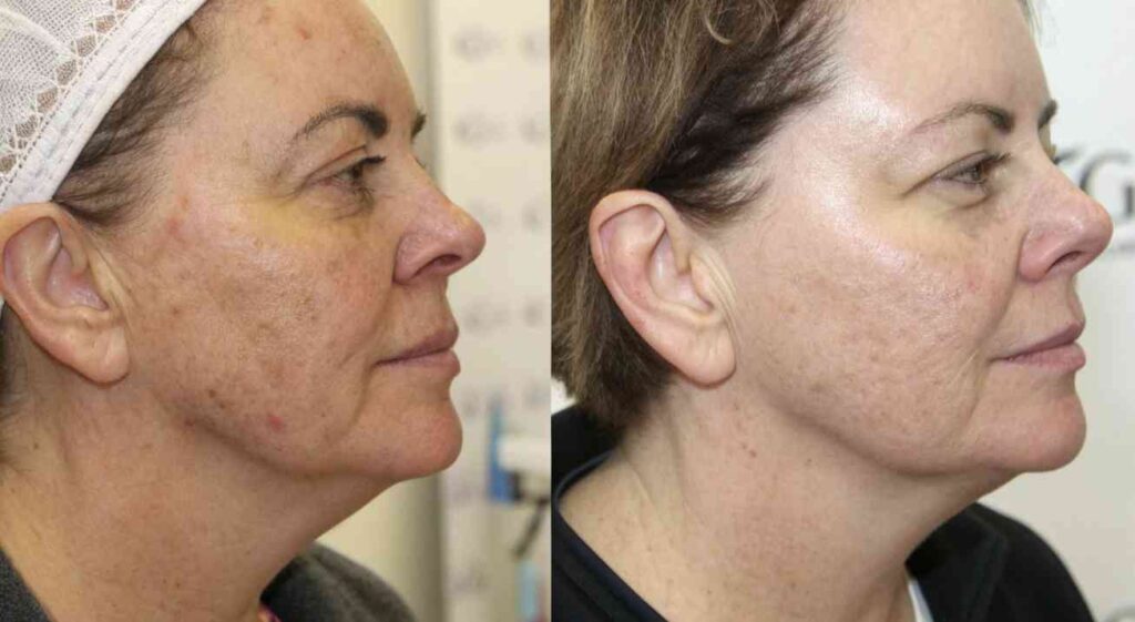 rejuvenecimiento facial