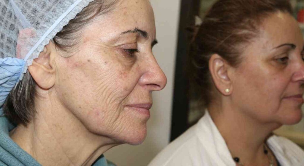 rejuvenecimiento facial