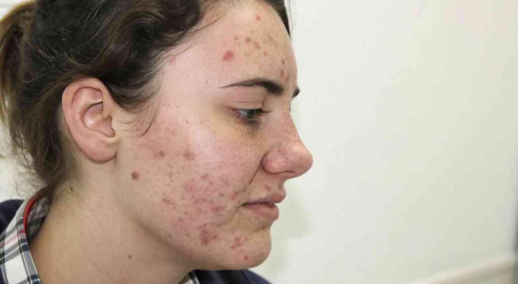 tratamiento de acne
